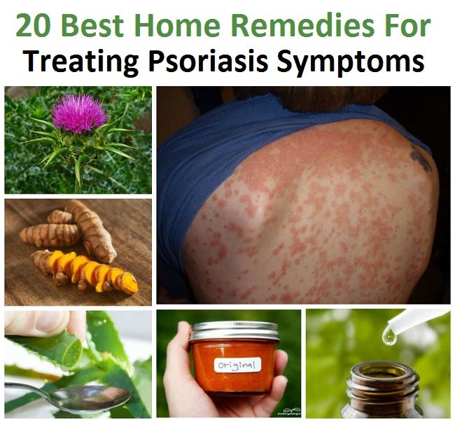 20 meilleurs remèdes maison pour le traitement des symptômes du psoriasis