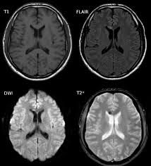 Un scan d'un cerveau qui a subi une commotion cérébrale.