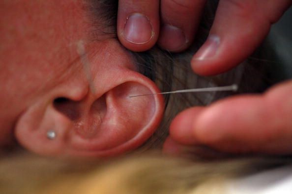 Acupuncture trouvé pour être efficace dans les douleurs de guérison et maux de tête