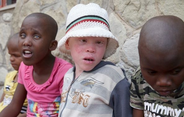 A des enfants atteints d'albinisme au Lesotho. Dans certaines régions d'Afrique les gens atteints d'albinisme sont chassé et tué ou mutilé.