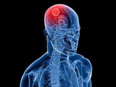 Les patients atteints d'une tumeur du cerveau, ou le glioblastome, peuvent supporter seulement un ou deux séances de chimiothérapie. La thérapie génique pourrait potentiellement augmenter leur tolérance, leur permettant de résister à plusieurs sessions.