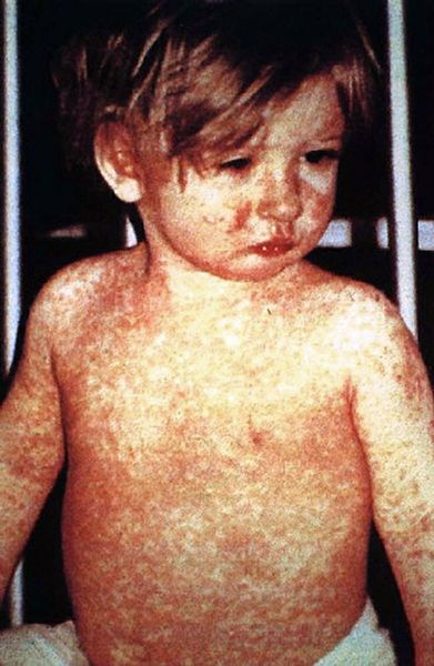 Un enfant avec une éruption de la rougeole typique. Une femme américaine est mort de la rougeole, ce printemps, le premier décès dû au virus aux États-Unis en 12 ans.