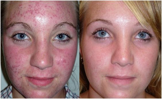 Comment Fade cicatrices d'acné y compris Home Remedies