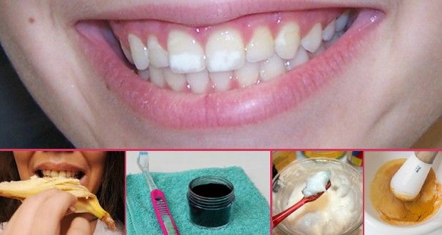 Comment se débarrasser des taches blanches sur les dents