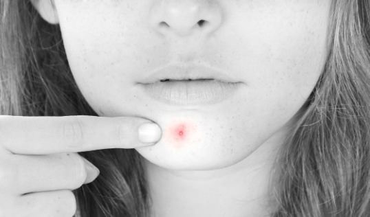 Comment réduire les rougeurs d'une Pimple?