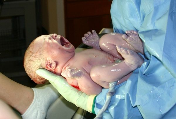 Augmentation du risque de décès chez les bébés de culasse lors de l'accouchement