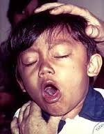 Un enfant souffrant de la coqueluche. La maladie provoque des quintes de toux violentes qui sont difficiles à contrôler.