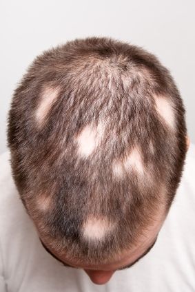 Les patients atteints de pelade ont augmenté cheveux en arrière après l'administration du médicament