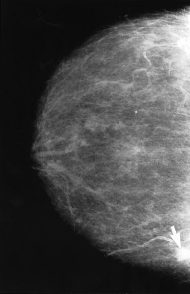 Mammographie avec le cancer Obvious