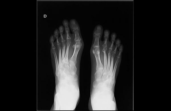 X-ray de pieds de quelqu'un avec la polyarthrite rhumatoïde.