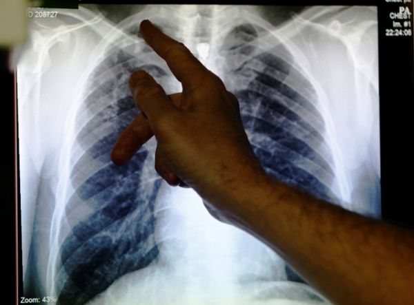 Chaudes Facteurs de risque Météo Augmentation pour les infections pulmonaires chroniques
