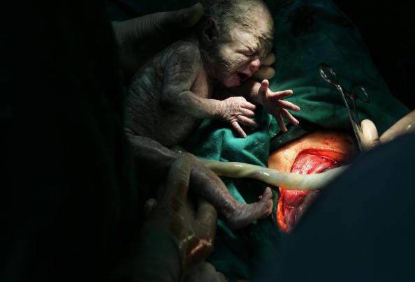 Femme tire ses bébés jumeaux sur son propre cours de césarienne