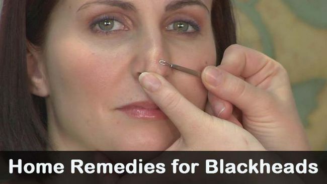 13 remèdes naturels rapides pour se débarrasser des points noirs