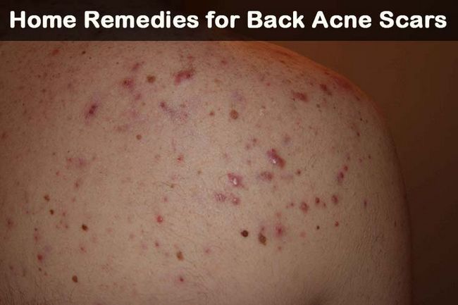 21 remèdes maison de bricolage pour le dos des cicatrices d'acné