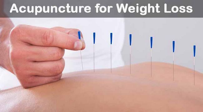 L'acupuncture pour la perte de poids