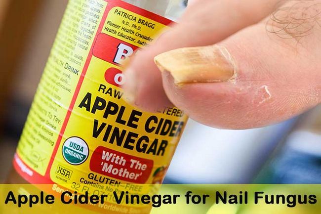 Apple Cider Vinegar pour les champignons des ongles