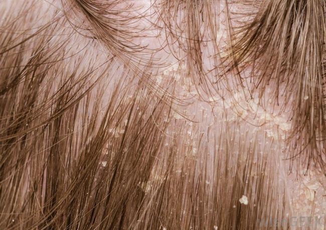 Pellicules remèdes maison pour les cheveux secs
