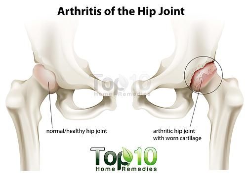 arthrite de l'articulation de la hanche