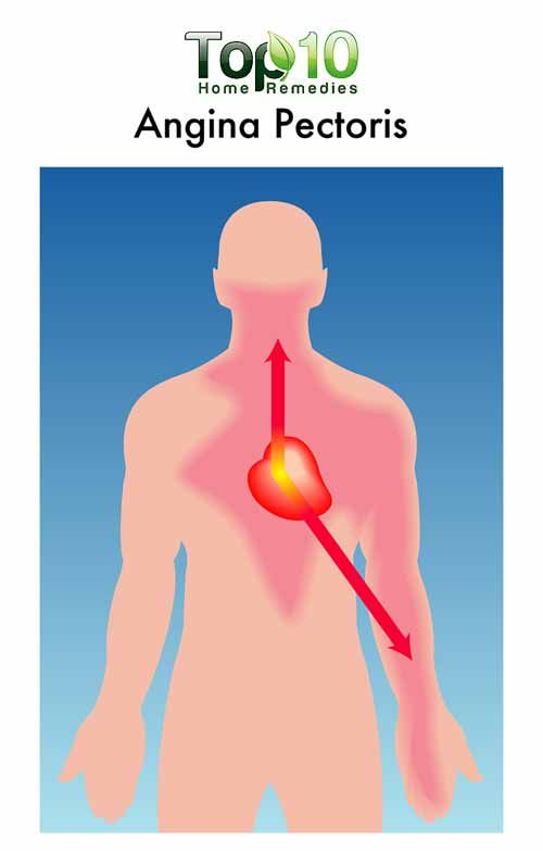 Schéma de l'angine de poitrine