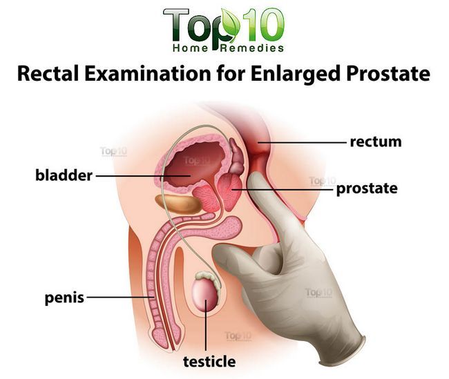 schéma à plus grande échelle de la prostate