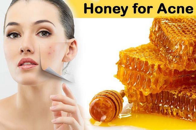 Miel pour l'acné