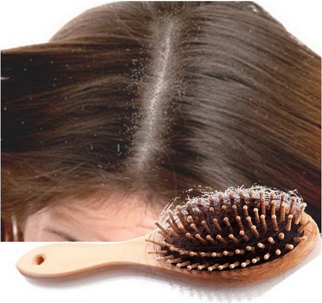 Comment arrêter la perte de cheveux due à des pellicules?