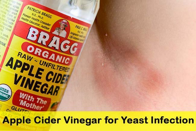 Apple Cider Vinegar pour les infections à levures