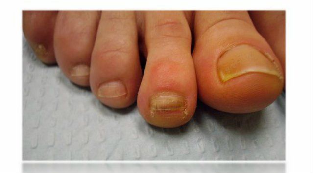 Symptômes de traumatisme à ongles, les causes et le traitement?