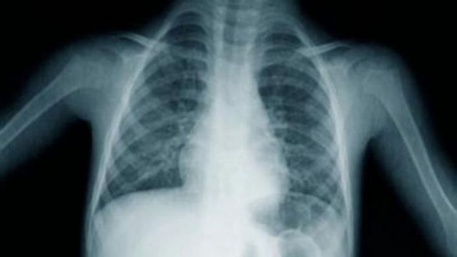 Une maladie pulmonaire rare chez les enfants - une nouvelle thérapie génique et cellulaire