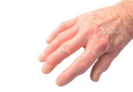 arthrite dans les mains