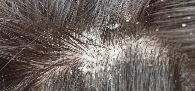Top 10 des remèdes maison pour guérir champignon cheveux