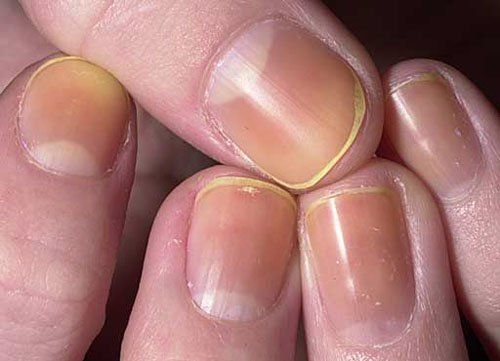 Quel est le syndrome des ongles jaunes et ses remèdes