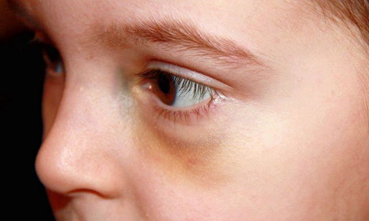 15 remèdes maison pour se débarrasser de Black Eye