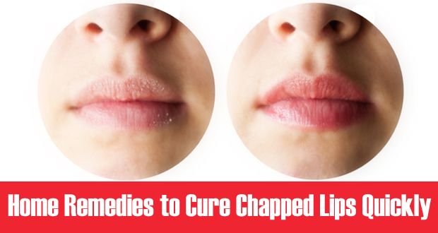 12 Facile remèdes maison pour les lèvres gercées