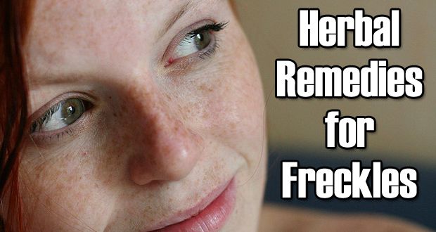 14 excellents remèdes à base de plantes pour Freckles