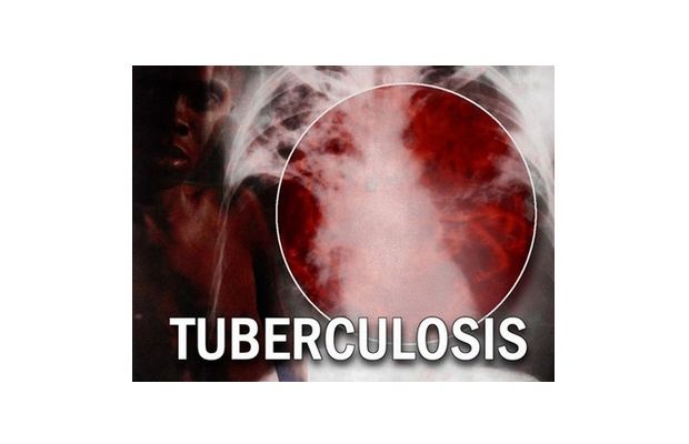 La tuberculose