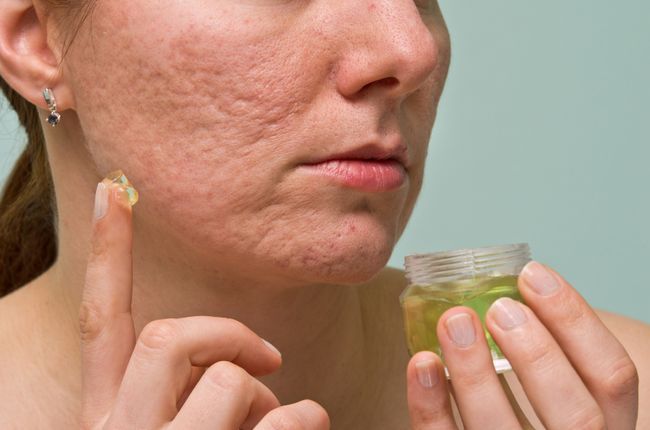 10 Super Clever moyens naturels pour éliminer l'acné Cicatrices