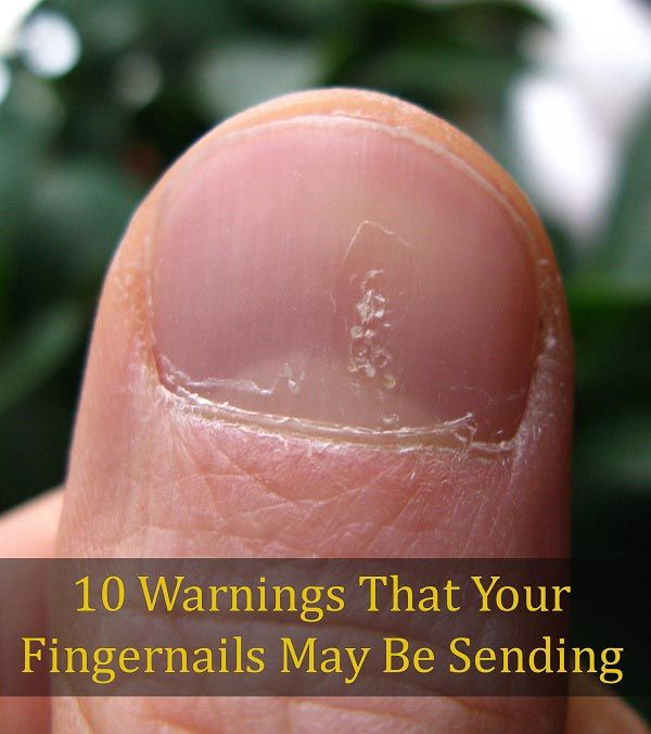 10 avertissements que vos ongles peuvent être envoient