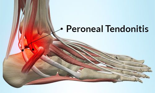 Accueil recours pour Tendinite pied