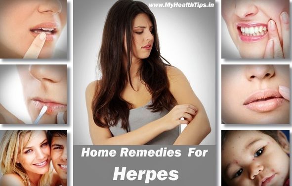 Efficaces remèdes maison pour l'herpès