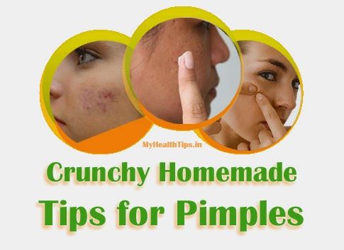 Conseils maison pour des boutons