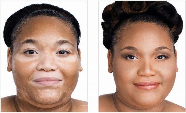 Accueil rapides Remèdes pour le vitiligo