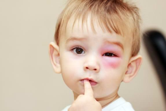 Bee Sting traitement Home Remedies