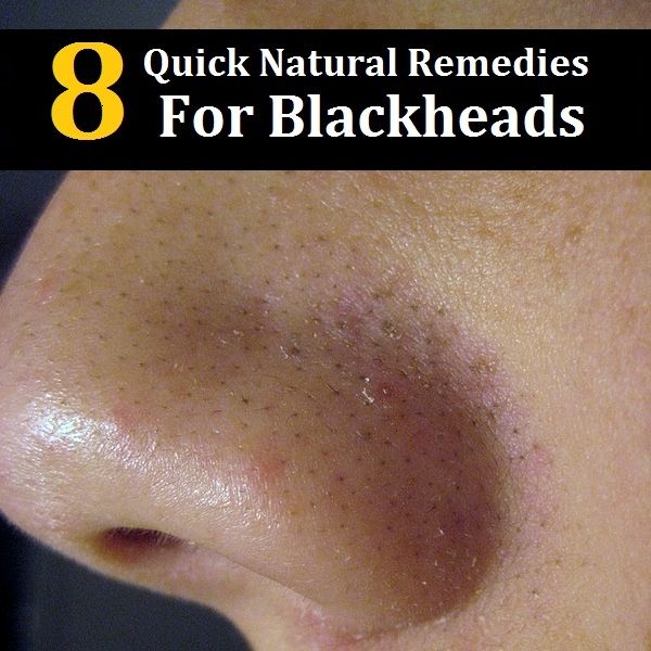 8 Remèdes naturels rapides pour les points noirs