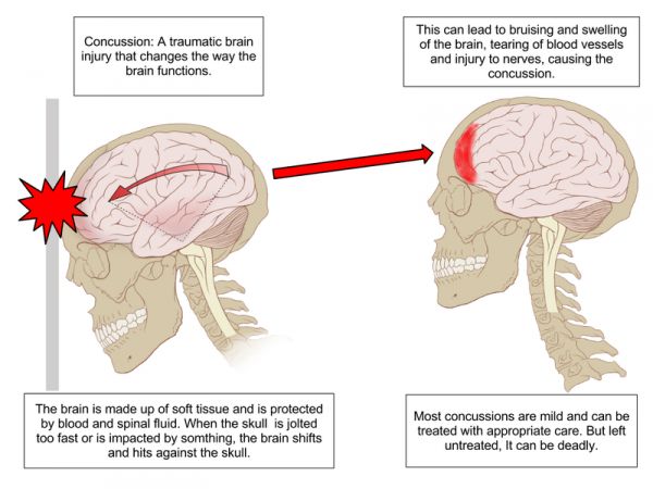 Qu'advient-il de votre cerveau au cours d'une commotion cérébrale.