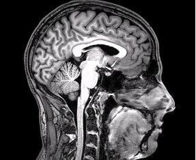 Un nouveau système de notation peut aider à prédire les problèmes cognitifs