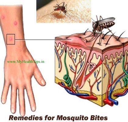 Mosquito Bites-remèdes