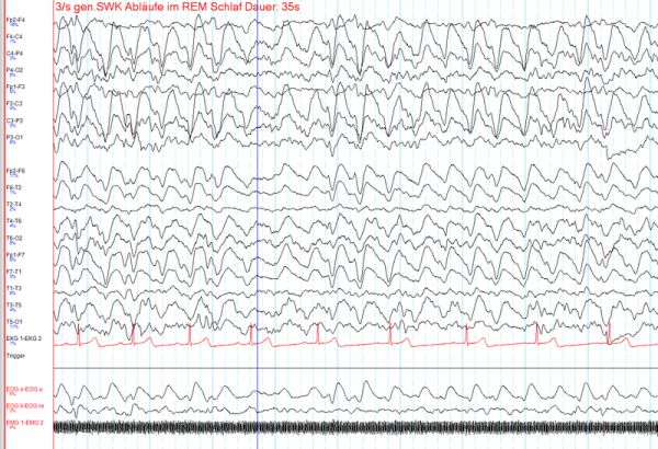 Un électroencéphalogramme (EEG) peut yeild un nouveau test pour le TDAH.