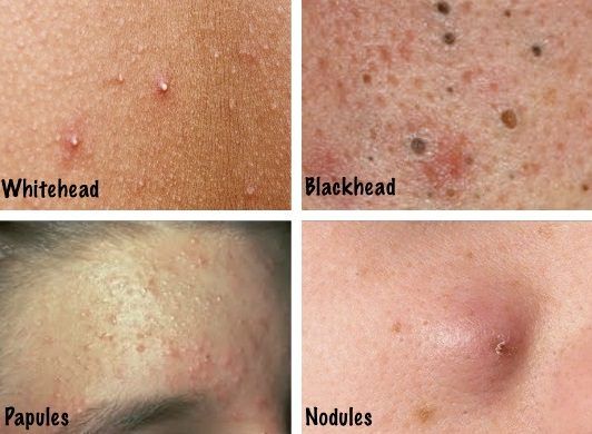 Types d'acné différentes et des façons de les identifier?