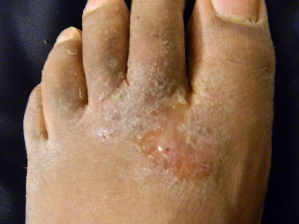 Athlète's foot is a painful and itchy condition on your feet